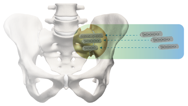 3D implants into Pelvis_June 2019-01 si-bone